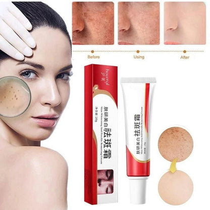 Melasma And Freckle Remover Cream 20g