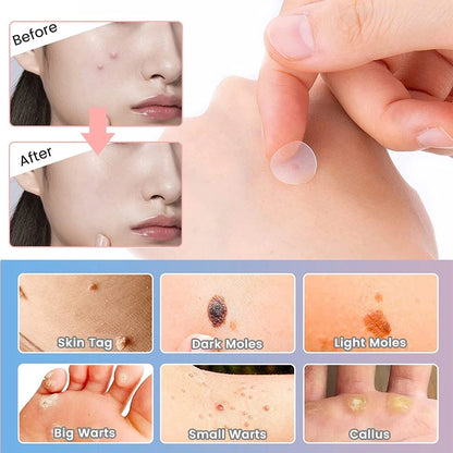 72 PCS Salicylic Pimple Patch Blemish Treatment