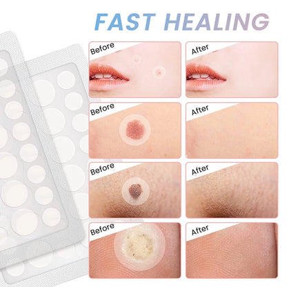 72 PCS Salicylic Pimple Patch Blemish Treatment