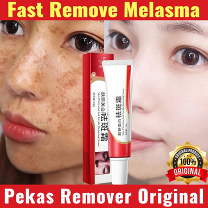 Melasma And Freckle Remover Cream 20g