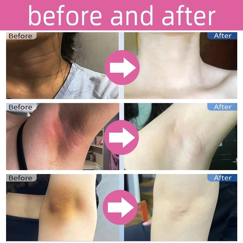 BUY 1 TAKE 1 | KORMESIC Kojic Acid Collagen Underarm Whitening Cream