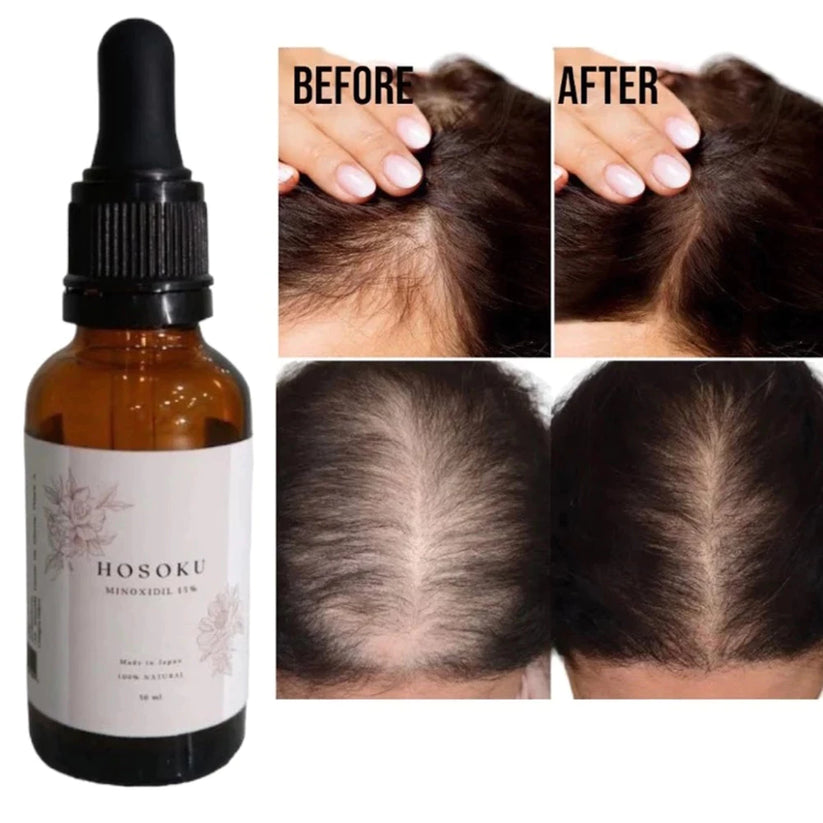 BUY 1 GET 1! HOSOKU 15% Minoxidil Hair Growth Serum (Oil Based)