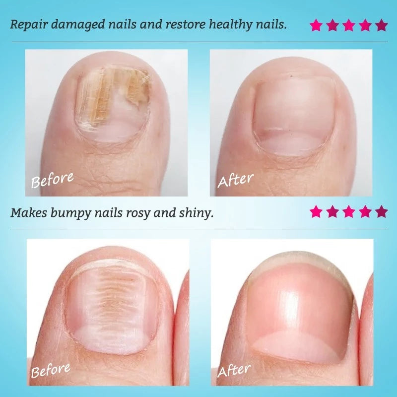 RtopR Ginger Antibacterial Nail Treatment
